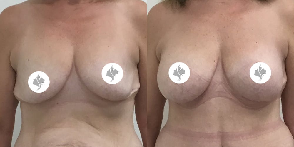 This is one of our beautiful breast reduction patient #44