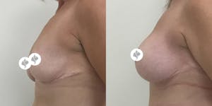 This is one of our beautiful breast reduction patient 44
