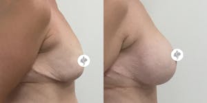 This is one of our beautiful breast reduction patient 44