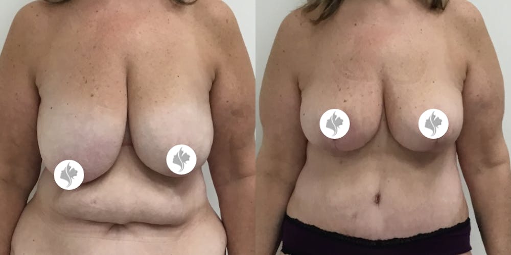 This is one of our beautiful breast reduction patient #45