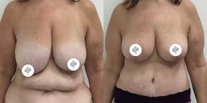This is one of our beautiful breast reduction patient 45