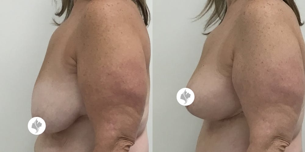 This is one of our beautiful breast asymmetry correction patient #12