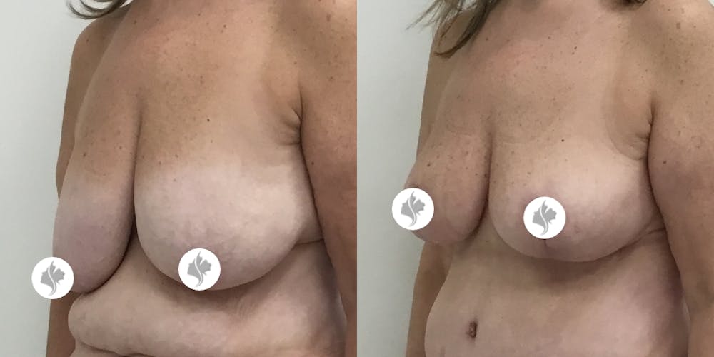 This is one of our beautiful breast asymmetry correction patient #12