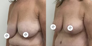 This is one of our beautiful breast asymmetry correction patient 12