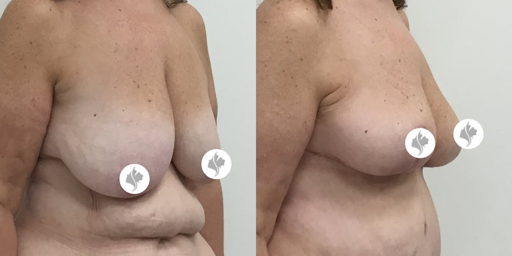 This is one of our beautiful breast reduction patient #45
