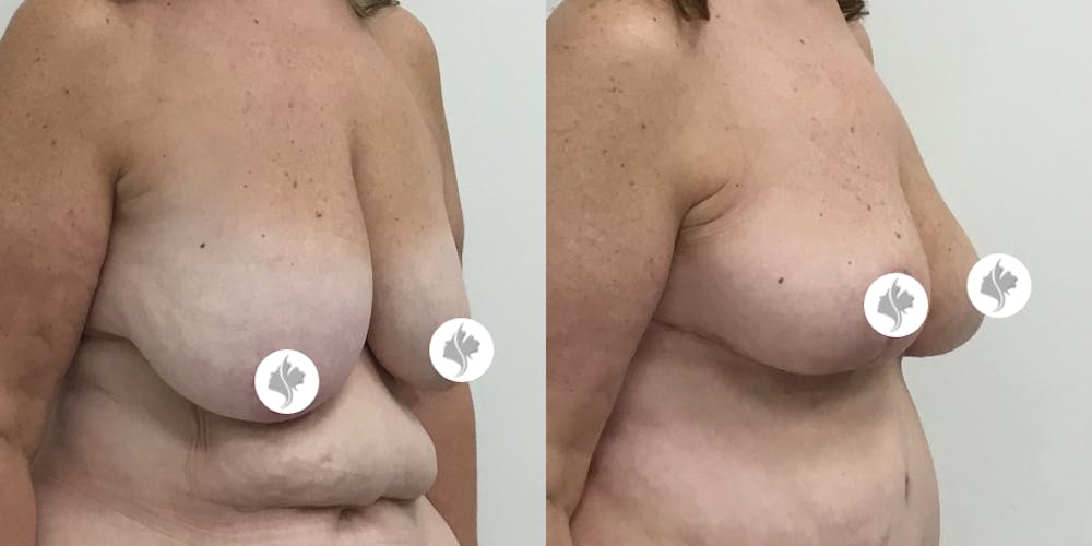 This is one of our beautiful breast asymmetry correction patient #12