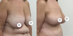 This is one of our beautiful breast asymmetry correction patient 12