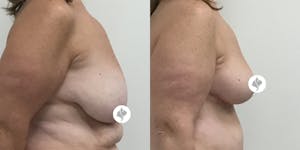 This is one of our beautiful breast asymmetry correction patient 12