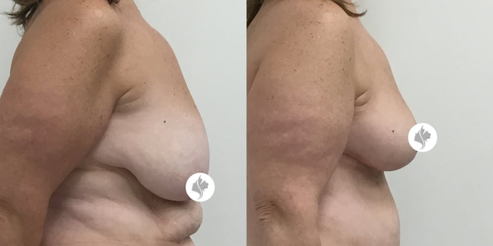 This is one of our beautiful breast asymmetry correction patient #12