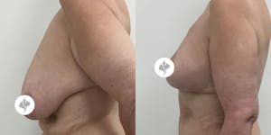 This is one of our beautiful breast reduction patient 46
