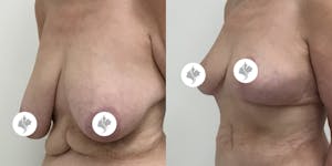 This is one of our beautiful breast reduction patient 46