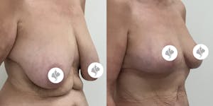 This is one of our beautiful breast reduction patient 46