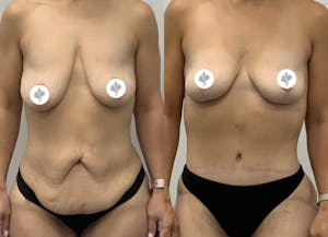 This is one of our beautiful tummy tuck patient 9