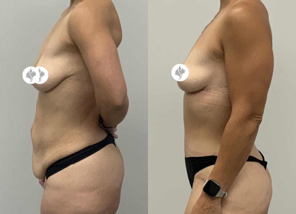 This is one of our beautiful tummy tuck patient #9