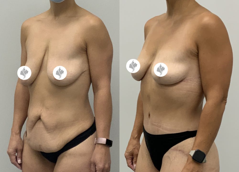 This is one of our beautiful tummy tuck patient #9