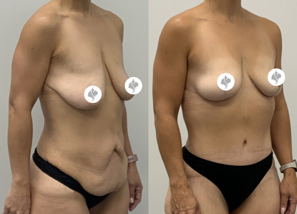 This is one of our beautiful tummy tuck patient #9