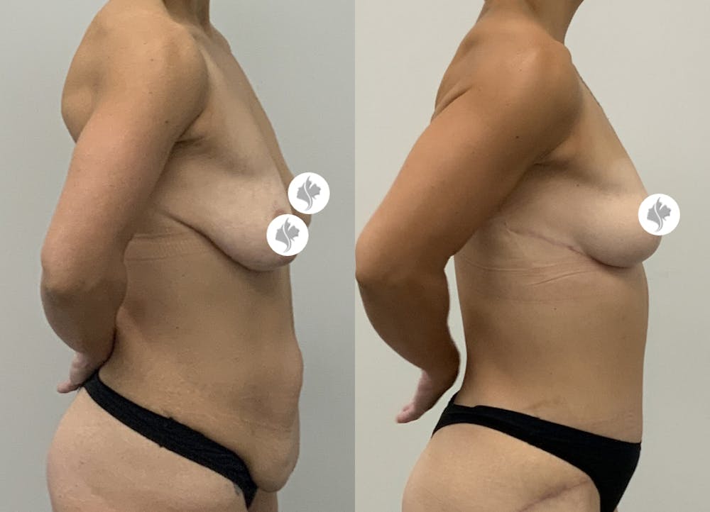 This is one of our beautiful tummy tuck patient #9