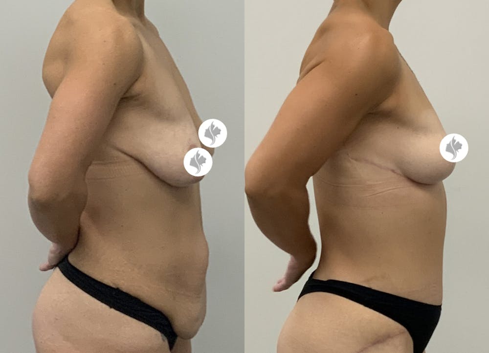 This is one of our beautiful post-bariatric body contouring patient #12