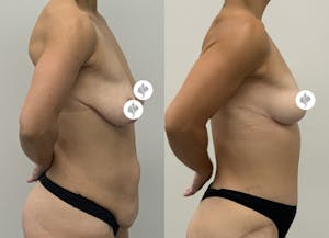 This is one of our beautiful post-bariatric body contouring patient 12