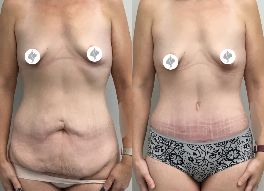 This is one of our beautiful tummy tuck patient 26