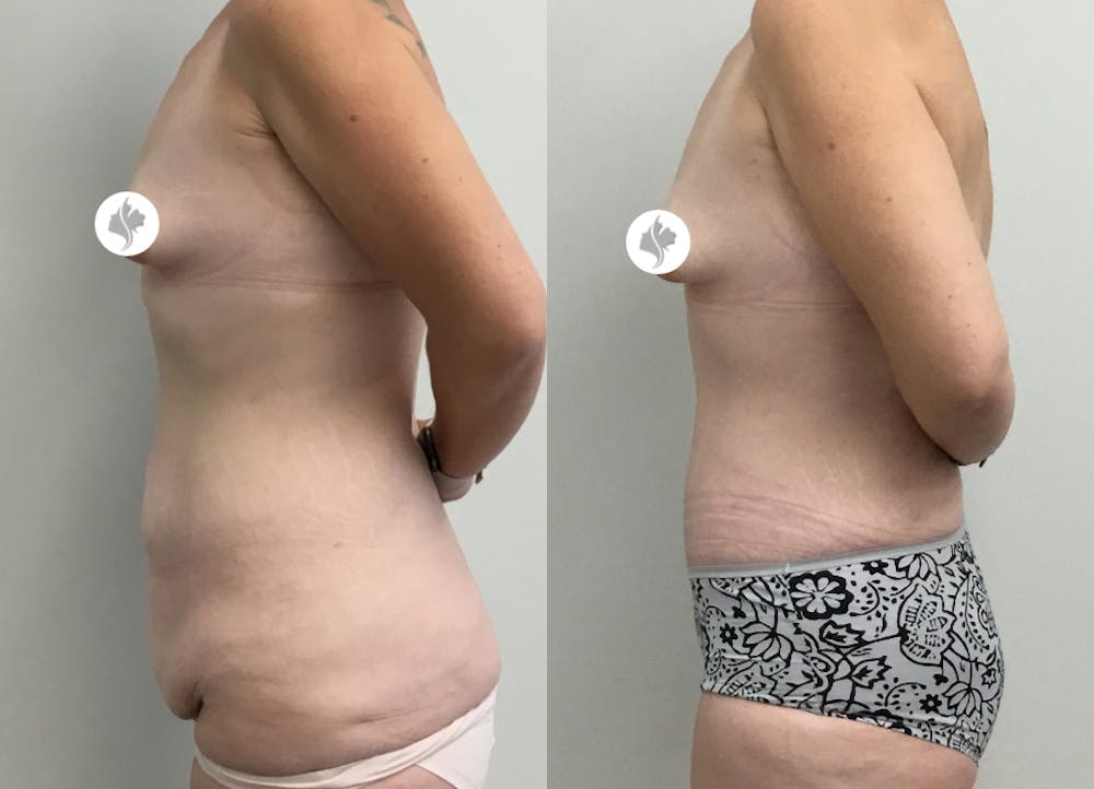 This is one of our beautiful tummy tuck patient #26