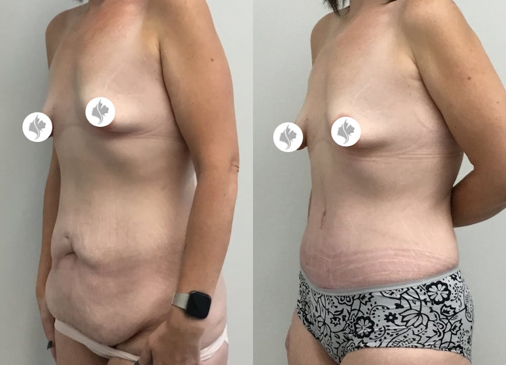 This is one of our beautiful tummy tuck patient #26