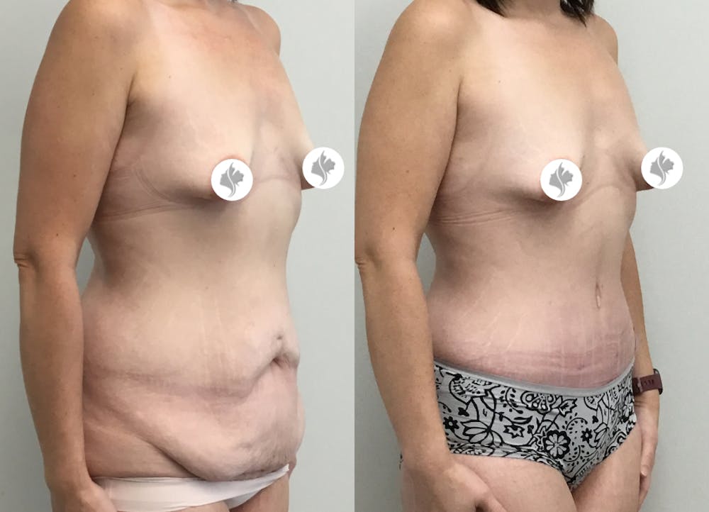 This is one of our beautiful tummy tuck patient #26