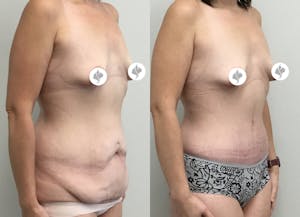 This is one of our beautiful tummy tuck patient 22
