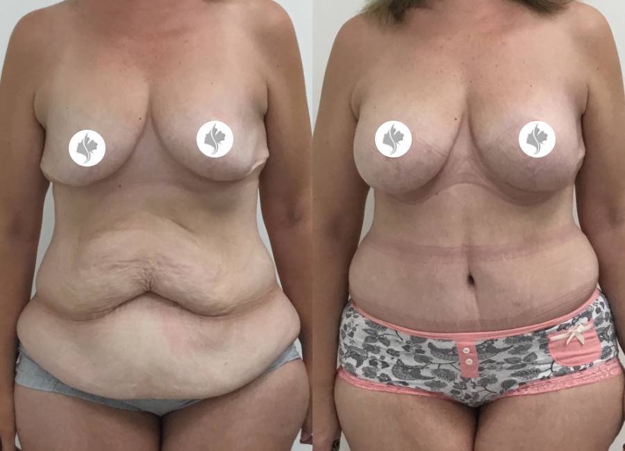 This is one of our beautiful post-bariatric body contouring patient 13