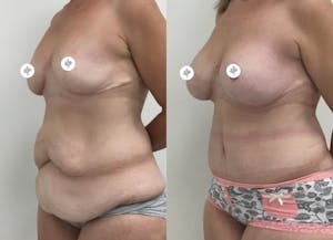 This is one of our beautiful tummy tuck patient 29