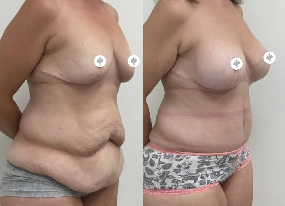 This is one of our beautiful tummy tuck patient #33