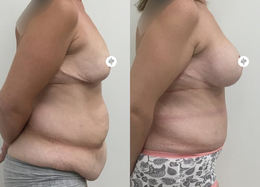 This is one of our beautiful post-bariatric body contouring patient #13