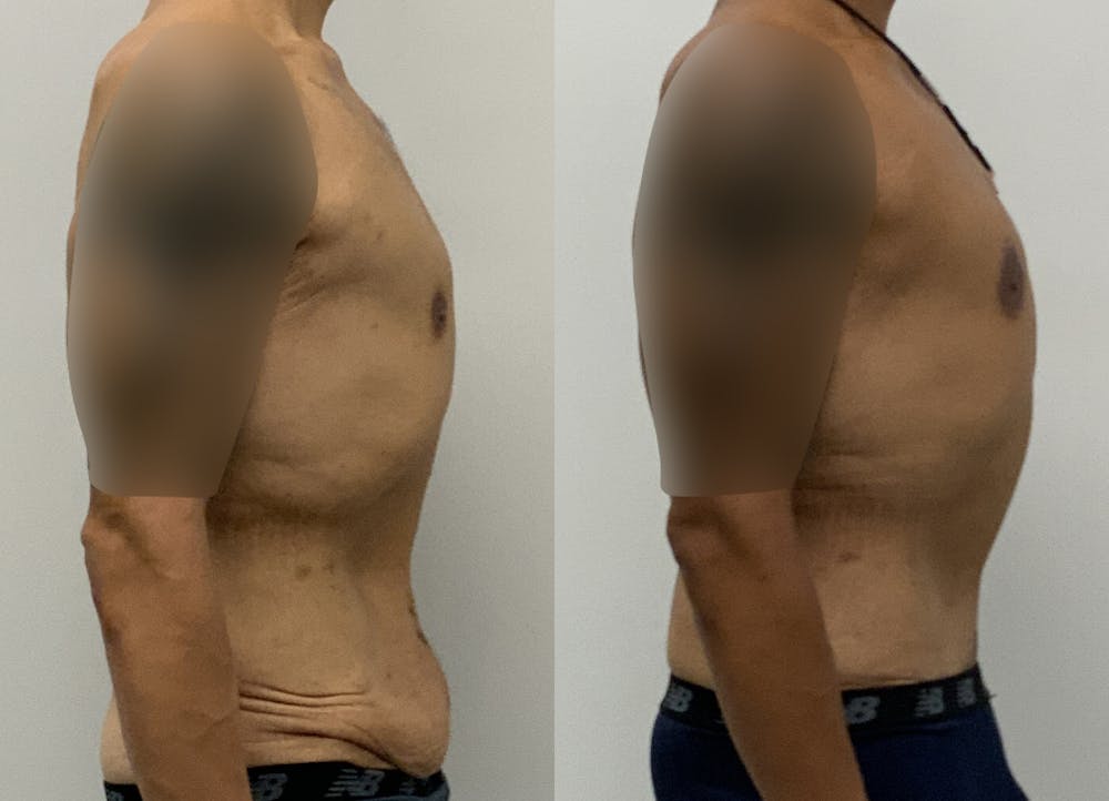 This is one of our beautiful tummy tuck patient #23