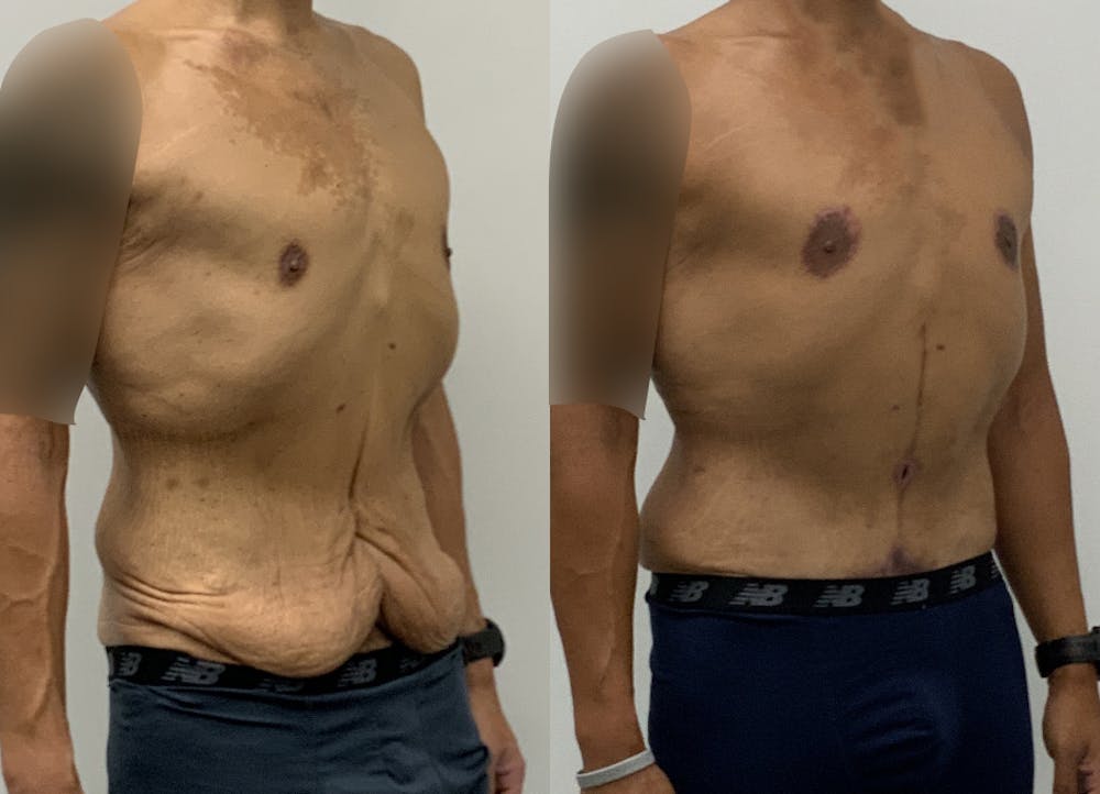 This is one of our beautiful tummy tuck patient #23