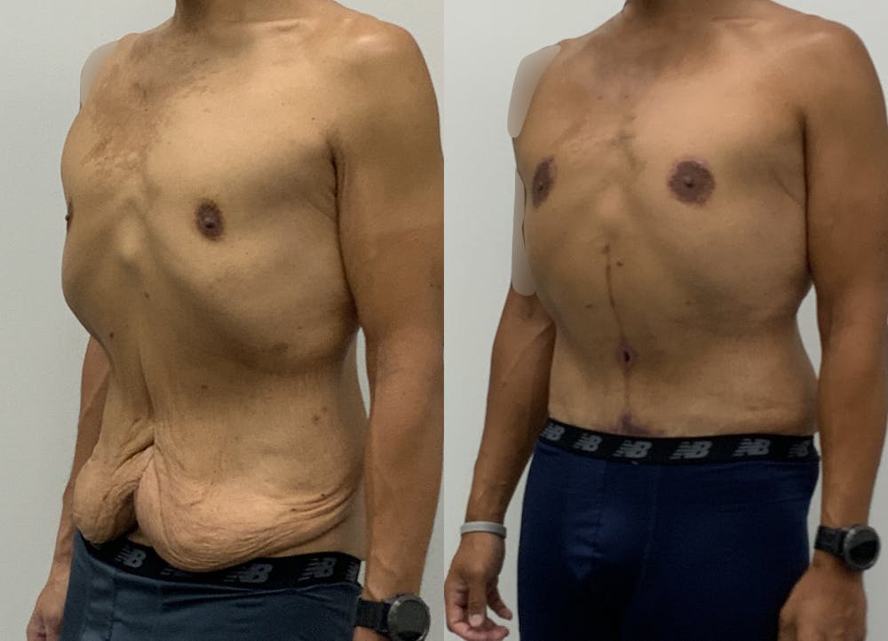 This is one of our beautiful tummy tuck patient #23