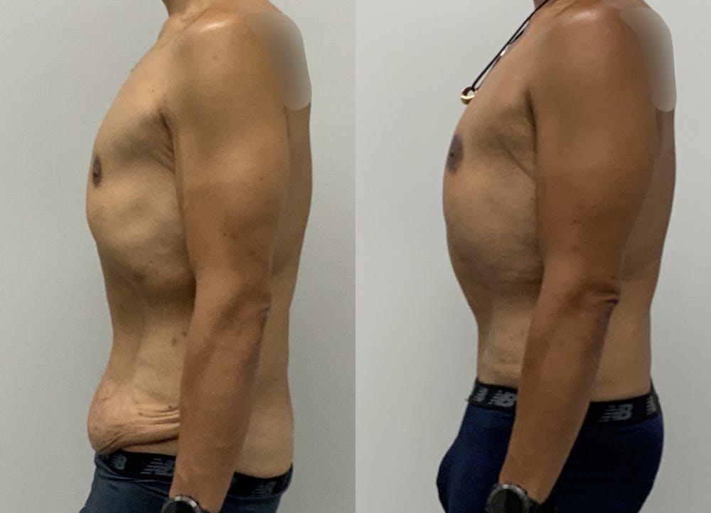 This is one of our beautiful tummy tuck patient #23