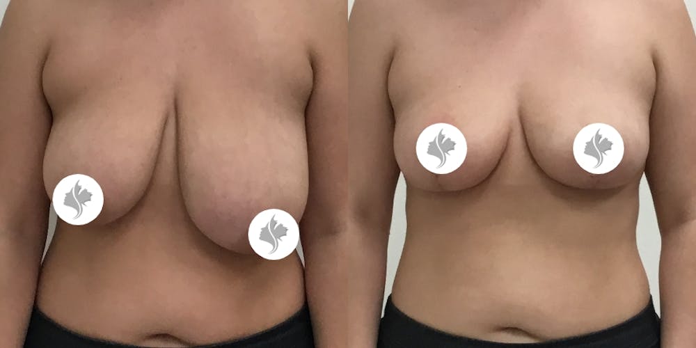 This is one of our beautiful breast reduction patient #2