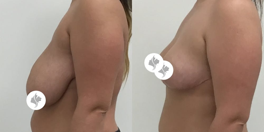 This is one of our beautiful breast asymmetry correction patient #1