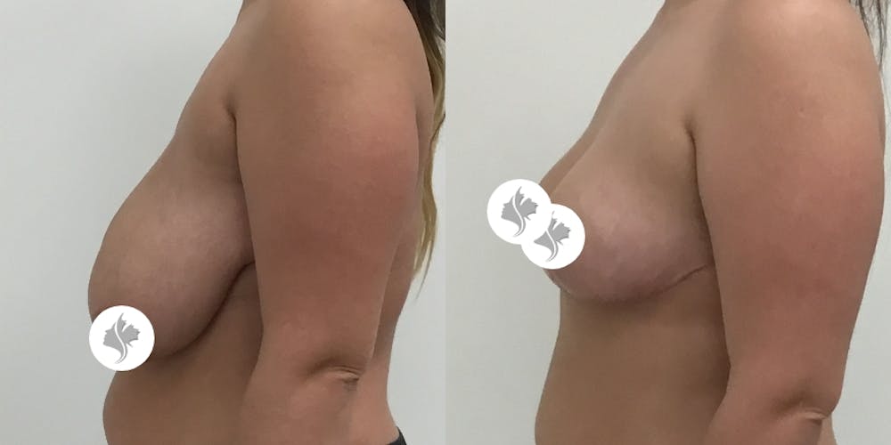 This is one of our beautiful breast reduction patient #2