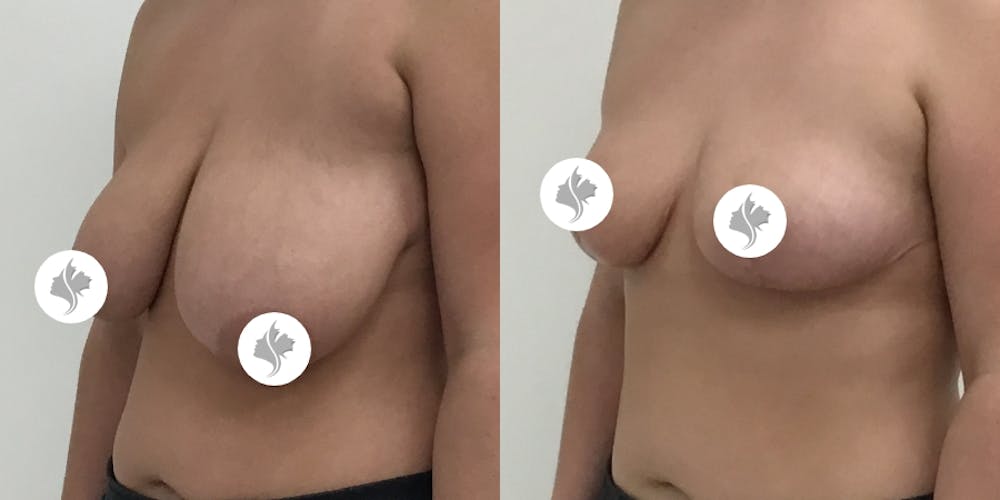 This is one of our beautiful breast asymmetry correction patient #1