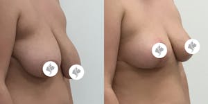 This is one of our beautiful breast asymmetry correction patient 1