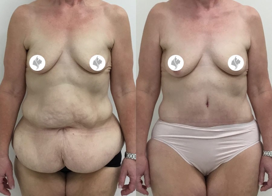 This is one of our beautiful post-bariatric body contouring patient 14