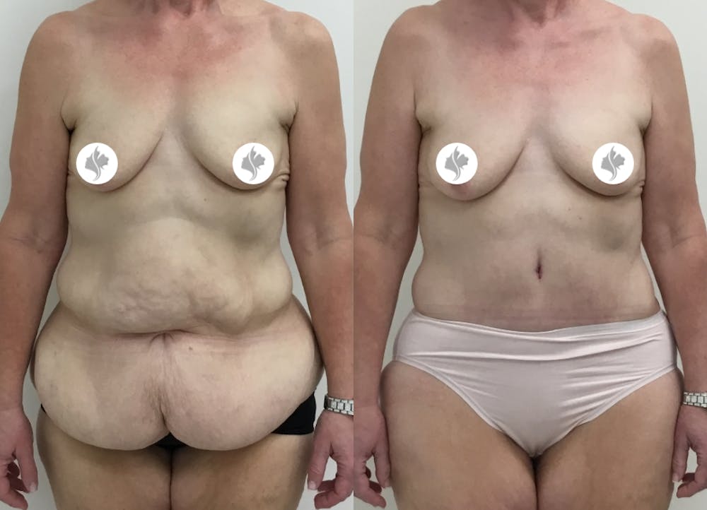 This is one of our beautiful tummy tuck patient #30