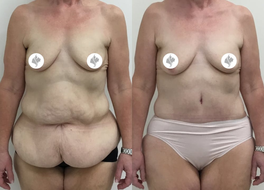 This is one of our beautiful post-bariatric body contouring patient #14