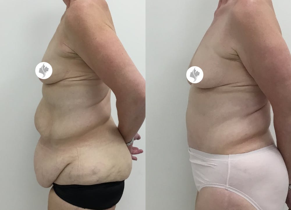 This is one of our beautiful post-bariatric body contouring patient #14