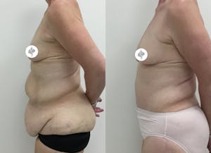 This is one of our beautiful post-bariatric body contouring patient 14