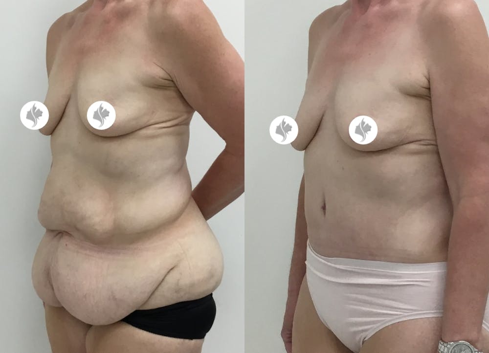 This is one of our beautiful tummy tuck patient #34