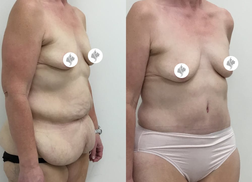 This is one of our beautiful post-bariatric body contouring patient #14