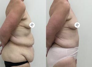 This is one of our beautiful post-bariatric body contouring patient 14