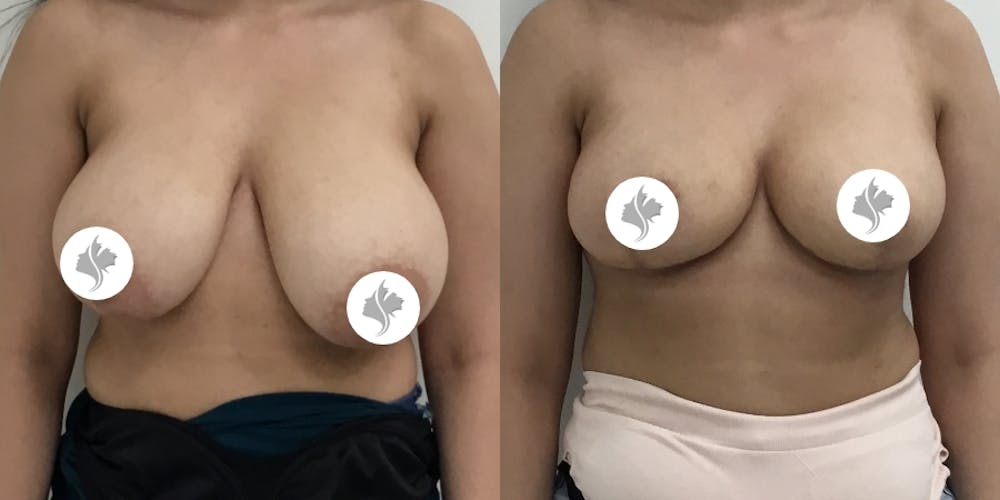 This is one of our beautiful breast asymmetry correction patient #2